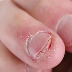 Fingernail to underlying skin directional terms