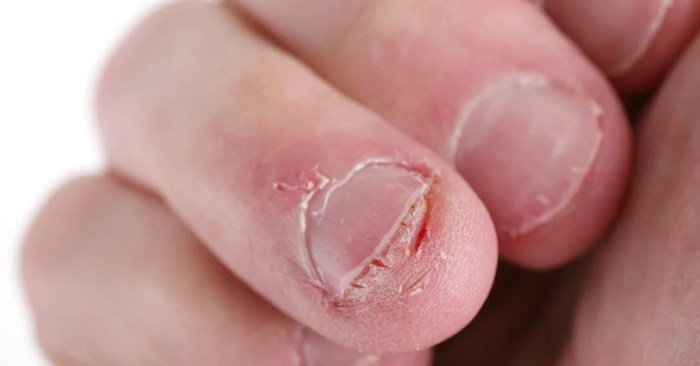 Fingernail to underlying skin directional terms