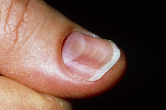 Fingernail to underlying skin directional terms